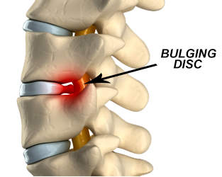 Discusbulging Rug Bulging Disc - Dr. Abhijit Pawar